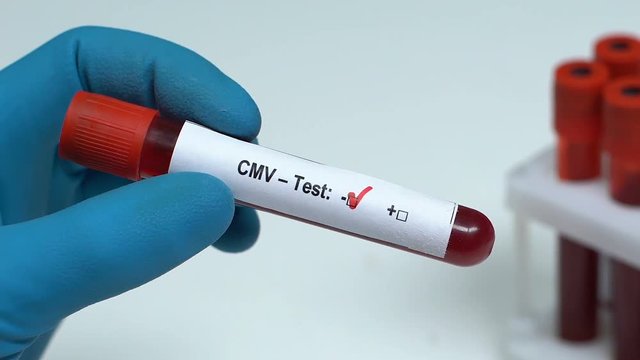 CMV-Test, doctor holding blood sample in tube close-up, health examination