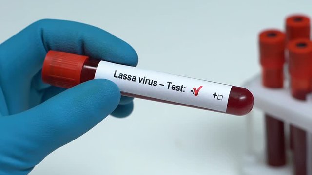 Lassa virus-Test, doctor holding blood sample in tube close-up, health check-up