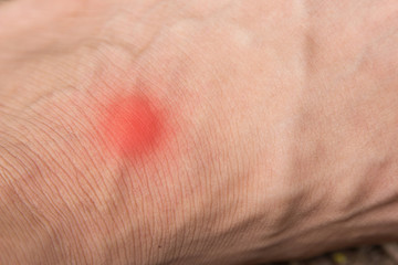 red hurt wound on human skin 