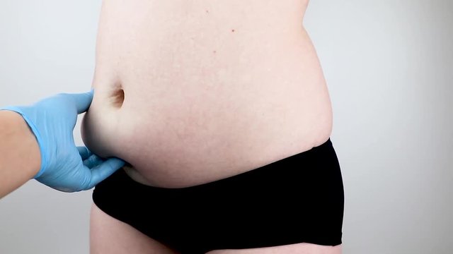 Abdominoplasty and torsoplasty: abdominal liposuction and removal of the apron. The patient at the reception at the plastic surgeon