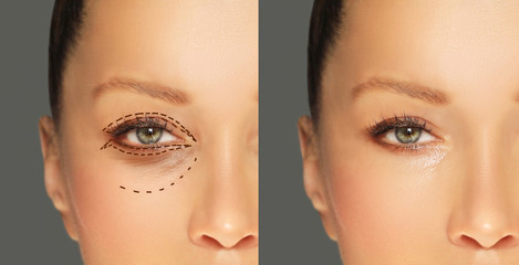 Lower and upper  Blepharoplasty.Marking the face.Perforation lines on females face, plastic surgery...