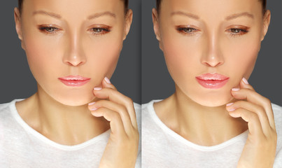 Beauty injections.Concept of rejuvenation.Lip augmentation