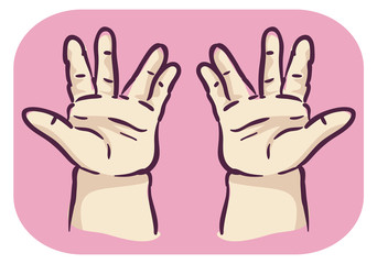 Hands Symptom Trident Hand Short Finger