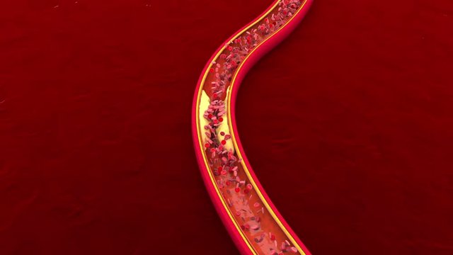3D rendered Animation of Hemoglobin cells flowing through a clogged Artery developing the illness Arteriosclerosis.