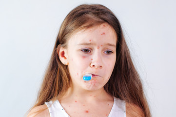 Closeup of cute sad little girl. Varicella virus or Chickenpox bubble rash on child