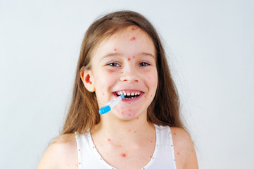 Closeup of cute funny little girl. Varicella virus or Chickenpox bubble rash on child