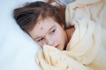 Closeup of cute sad little girl in bed. Varicella virus or Chickenpox bubble rash on child - obrazy, fototapety, plakaty