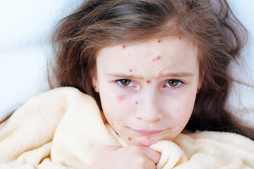 Closeup of cute sad little girl in bed. Varicella virus or Chickenpox bubble rash on child