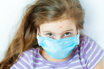 Closeup of cute little girl. Varicella virus or Chickenpox bubble rash on child