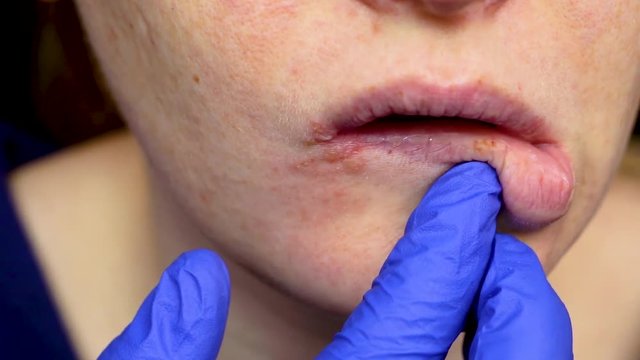 Herpes on the lips: a woman with a cold and the herpes virus is examined by a dermatologist and infectious disease specialist