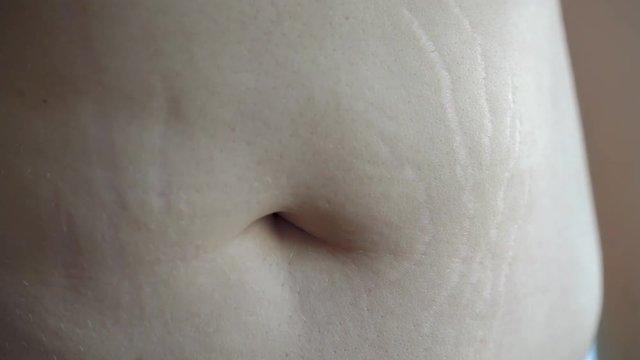 stretch marks on the girl's stomach