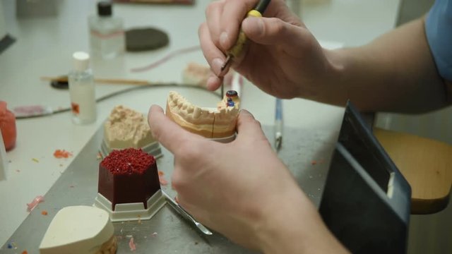 The dentist makes a mold of the teeth. prosthetic dentistry, dental prosthetics