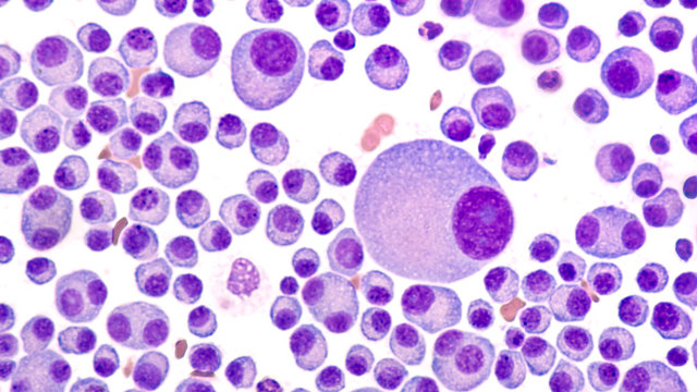 Multiple Myeloma Awareness: Bone marrow aspirate cytology of multiple myeloma, a type of bone marrow cancer of malignant plasma cells, associated with bone pain, bone  fractures and anemia.