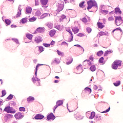 Microscopic image (photomicrograph) of a poorly differentiated gastric mucinous adenocarcinoma (stomach cancer), signet ring cell type. Tumor cells have appearance of a traditional signet ring. 