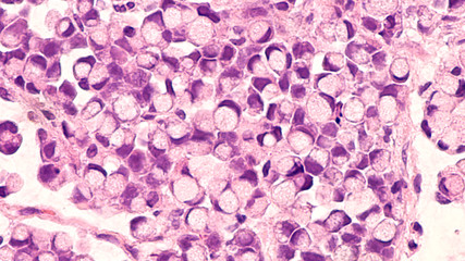 Microscopic image (photomicrograph) of a poorly differentiated gastric mucinous adenocarcinoma (stomach cancer), signet ring cell type. Tumor cells have appearance of a traditional signet ring. 