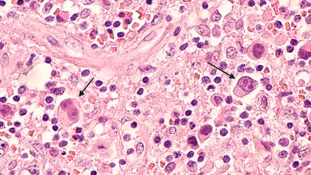 Microscopic image of a lymph node in a patient with Hodgkin's Disease (lymphoma), showing two Reed Sternberg cells in the same field.