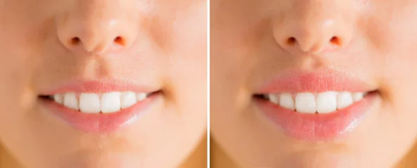 Fotobehang Woman's lips before and after filler injections © Kaspars Grinvalds