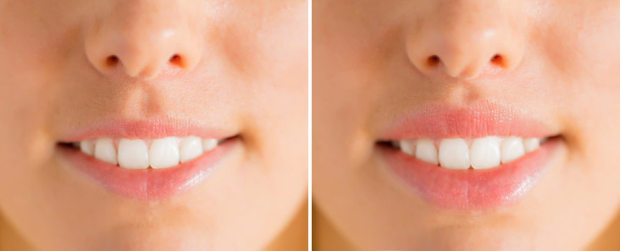 Woman's lips before and after filler injections