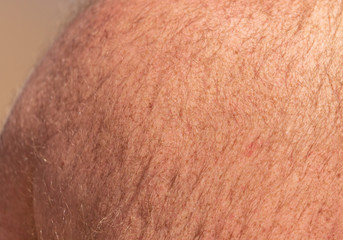 Fototapeta premium Hair grows on the back of a man