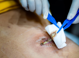 Nurse cleaning wound with cotton ball and dressing set.
