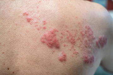 Fototapeta premium Shingles (Disease), Herpes zoster, varicella-zoster virus. skin rash and blisters