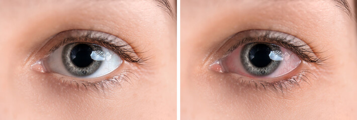 Young woman without and with eye redness, closeup
