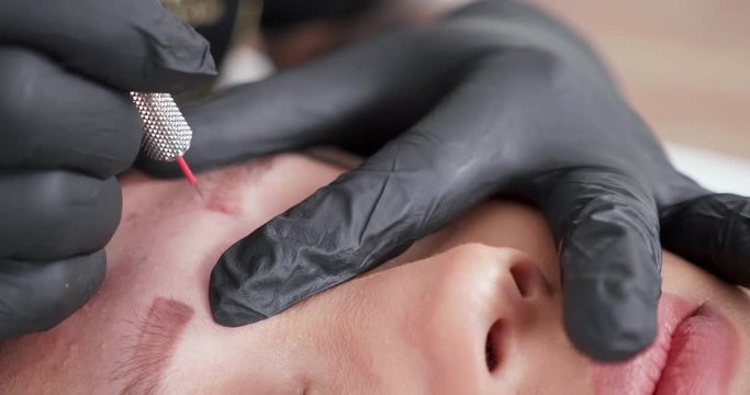Very close up shot of the procedure of tattoo removal. Woman with black gloves using a tool with micro needles to remove the paint from under the skin.