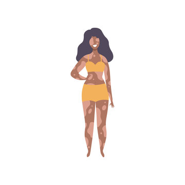 Happy Beautiful African American Woman with Vitiligo, Body Positive, Self Acceptance and Beauty Diversity Concept Vector Illustration