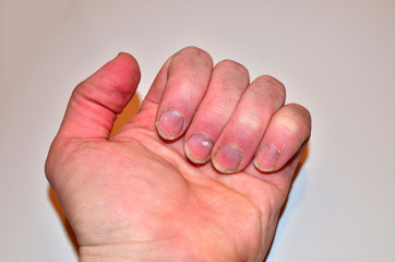 Male nails disease, fingernail lack of nutrients and do not make nail not shape and not care,...