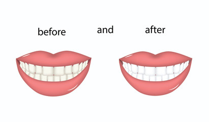 Fototapeta premium Whitening - Female teeth before and after - isolated on white background - flat style - vector