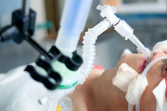 Patient in critical state. Intubated adult white man under AVL lying in coma in intensive care department.