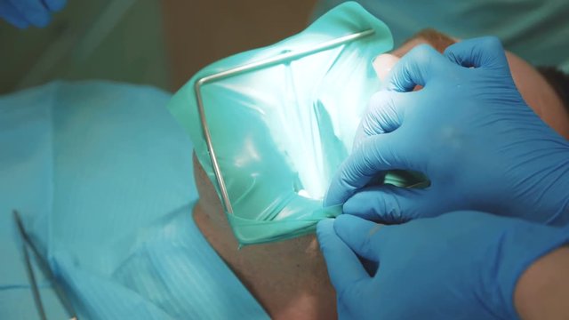 Dentist puts a cofferdam into patient's mouth. 4K