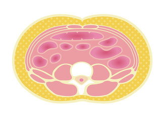 Type of obesity illustration . Abdominal sectional View (subcutaneous fat). 