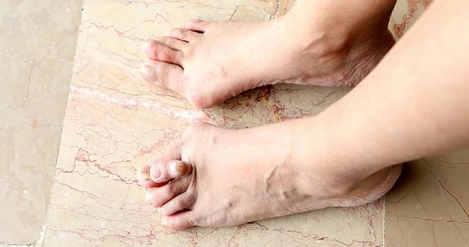 Female foots with bunion deformity