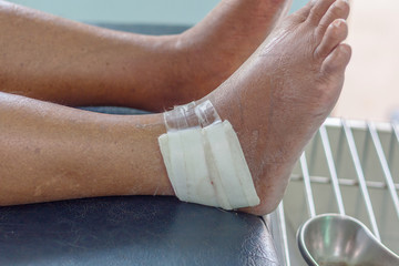gout ankle wound