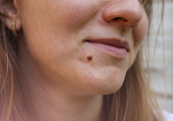 Big birthmark on the girl's skin. Medical health photo. Woman's face with wartpapilloma.