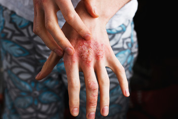 Man scratch oneself, dry flaky skin on hand with psoriasis vulgaris, eczema and other skin conditions like fungus, plaque, rash and patches. Autoimmune genetic disease. - obrazy, fototapety, plakaty