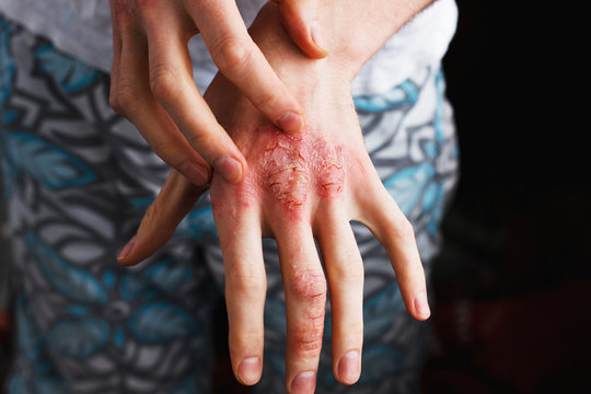 347 BEST Pustular IMAGES, STOCK PHOTOS u0026 VECTORS  Adobe Stock