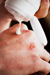 Fototapeta premium Eczema on the hands. The man applying the ointment , creams in the treatment of eczema, psoriasis and other skin diseases. Skin problem concept