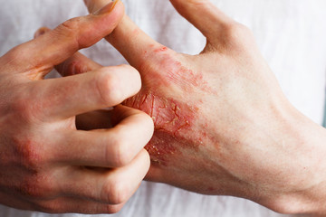 Man scratch oneself, dry flaky skin on hand with psoriasis vulgaris, eczema and other skin...