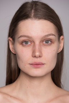 Young girl. problem skin. Pouring out on face. Without a make-up