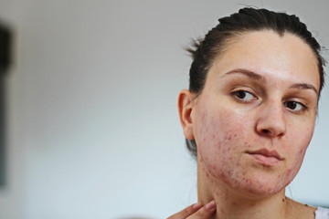 Acne on the face of young women. Improper therapy has led to a severe form of chronic inflammation...