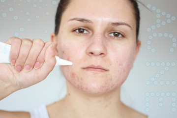 Acne on the face of young women. Improper therapy has led to a severe form of chronic inflammation...