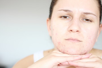 Acne on the face of young women. Improper therapy has led to a severe form of chronic inflammation...