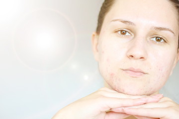 Acne on the face of young women. Improper therapy has led to a severe form of chronic inflammation...