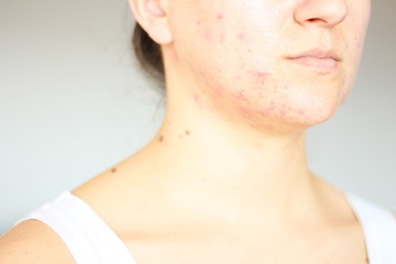 Acne on the face of young women. Improper therapy has led to a severe form of chronic inflammation...