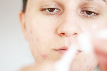 Acne on the face of young women. Improper therapy has led to a severe form of chronic inflammation...
