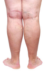 The varicose veins