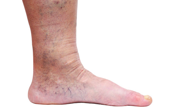 The varicose veins