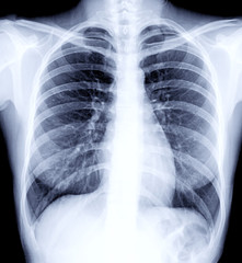 Radiographic image or X-Ray Image Of Human Chest for a medical diagnosis . check up concept.